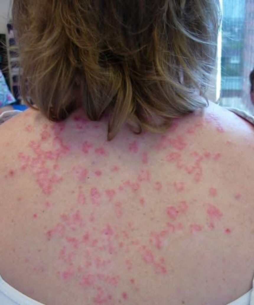 Sleep Rash Here are the consequences of sleeping with… – The Daily Beat